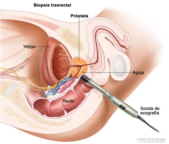 Avanza en Cuba estudio de vacuna terapéutica para cáncer de próstata Avanza en Cuba estudio de vacuna terapéutica para cáncer de próstata