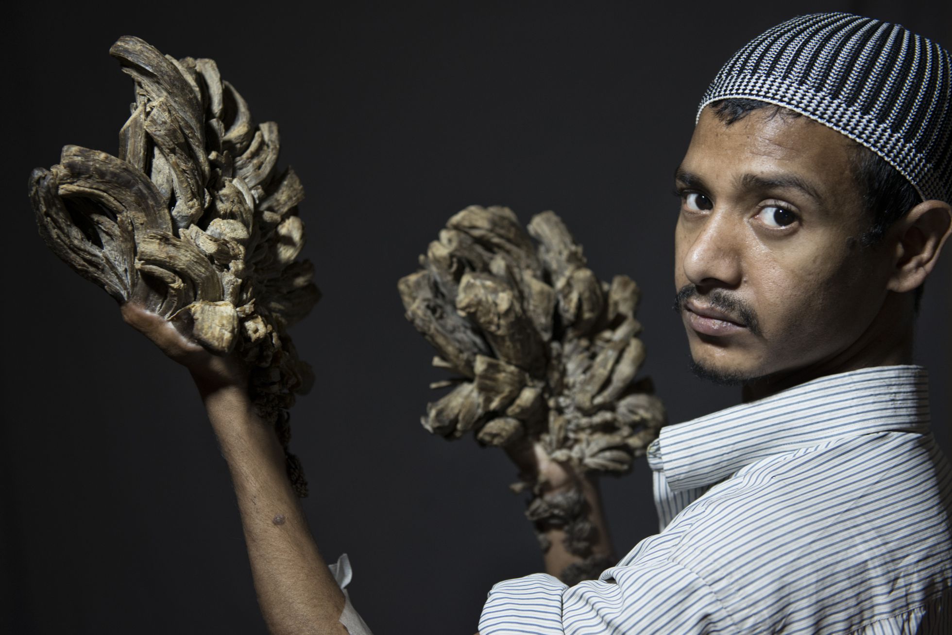 Abul Bajandar, el Hombre árbol