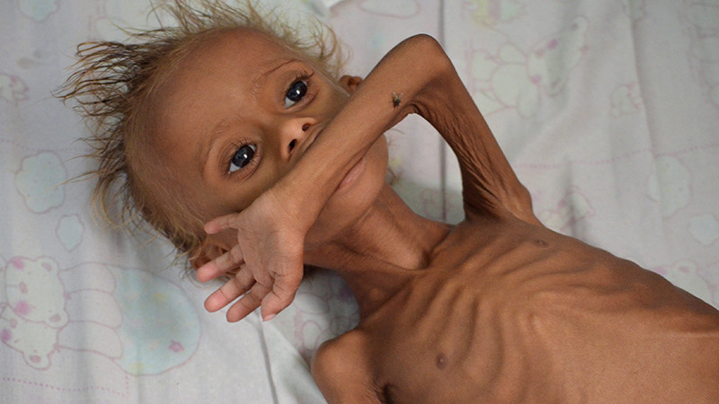 Niños famélicos en Yemen