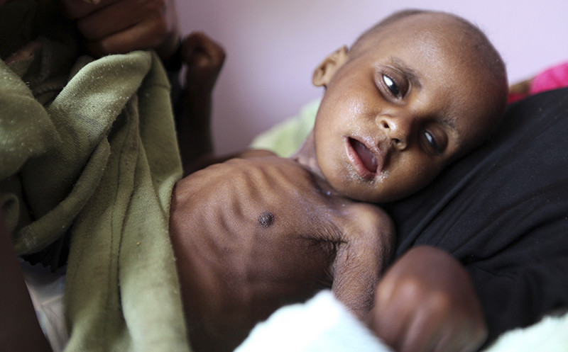 Niños famélicos en Yemen 