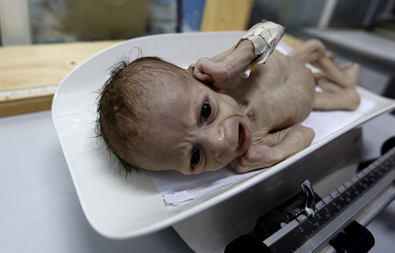 Niños famélicos en Yemen 
