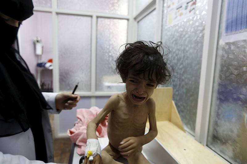 Niños famélicos en Yemen 