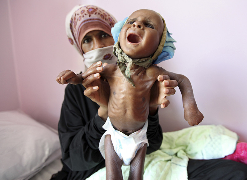 Niños famélicos en Yemen 