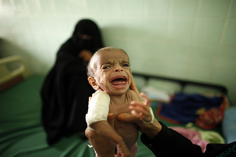 Niños famélicos en Yemen 