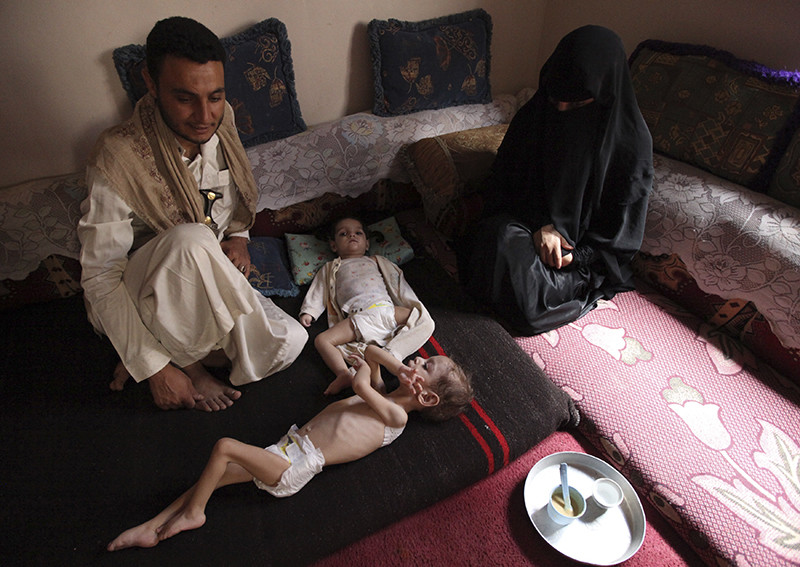 Niños famélicos en Yemen