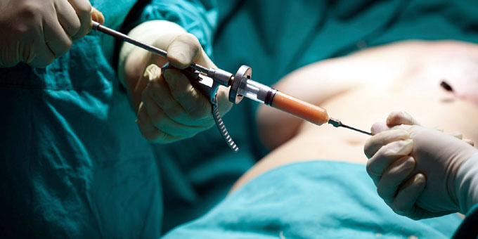 Una liposucción efectiva depende del paciente, afirman en Cuba Una liposucción efectiva depende del paciente, afirman en Cuba