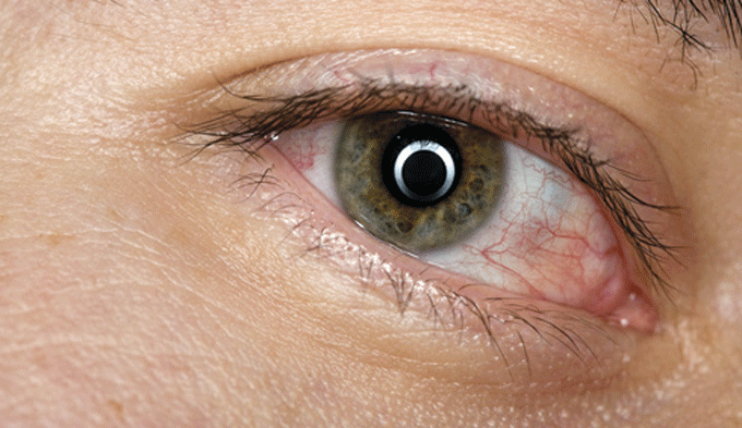 La conjuntivitis puede dejar secuelas si no se detecta precozmente La conjuntivitis puede dejar secuelas si no se detecta precozmente