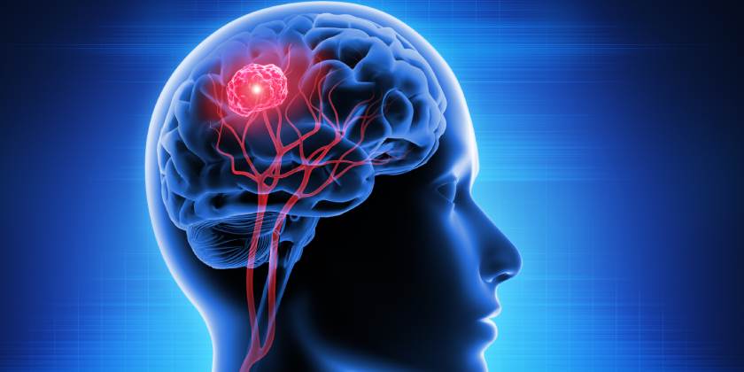 Desarrollan equipo electromagnético para combatir cáncer cerebral Desarrollan equipo electromagnético para combatir cáncer cerebral
