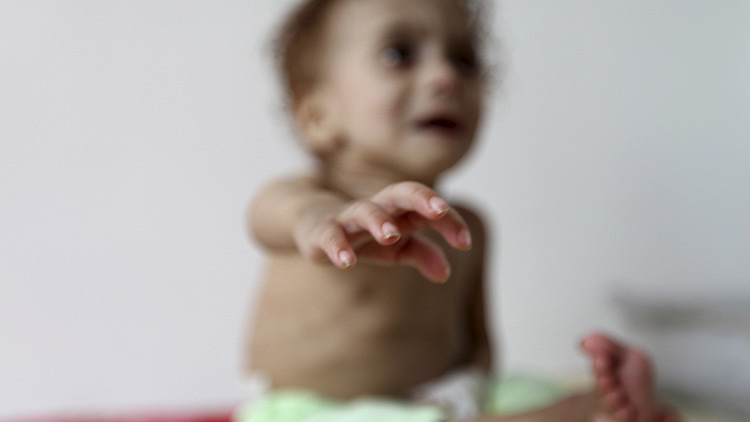 Yemen: espeluznantes imágenes de niños famélicos nos muestran la crueldad de una guerra olvidada Yemen: espeluznantes imágenes de niños famélicos nos muestran la crueldad de una guerra olvidada