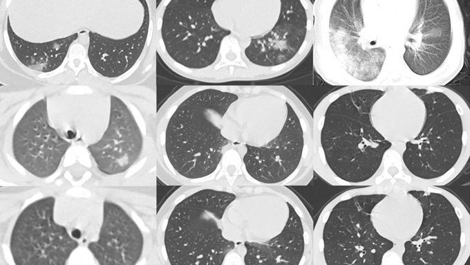 Un estudio de tomografías computarizadas revela cómo el coronavirus puede afectar los pulmones de un niño (+video) Un estudio de tomografías computarizadas revela cómo el coronavirus puede afectar los pulmones de un niño (+video)