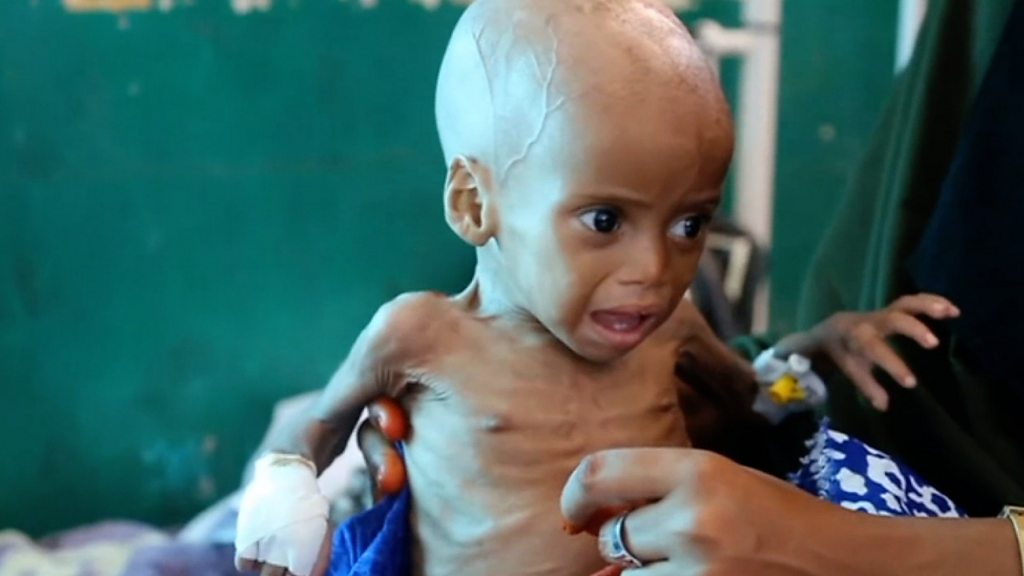 ONU alerta de crisis nutricional que amenaza a niños ONU alerta de crisis nutricional que amenaza a niños