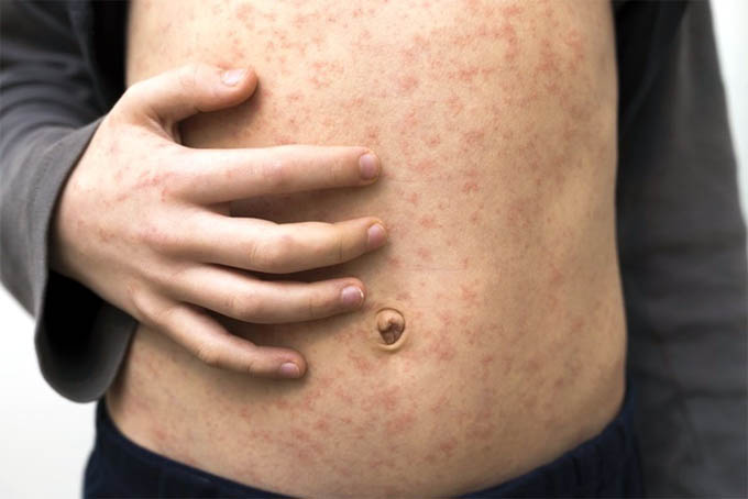 OMS preocupada por hepatitis aguda y brotes de sarampión OMS preocupada por hepatitis aguda y brotes de sarampión