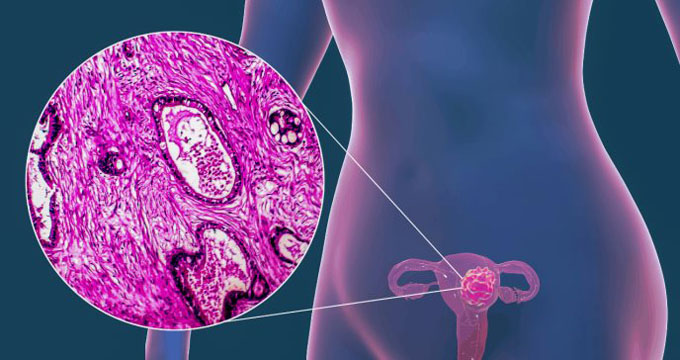 India lanzará vacuna autóctona contra cáncer del cuello de útero India lanzará vacuna autóctona contra cáncer del cuello de útero