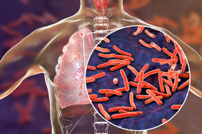 La Tuberculosis es prevenible y curable
