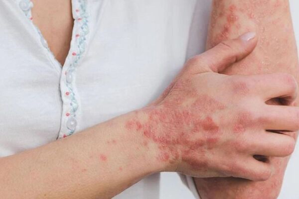 Se elevan a 167 los casos de mpox en Panamá Se elevan a 167 los casos de mpox en Panamá
