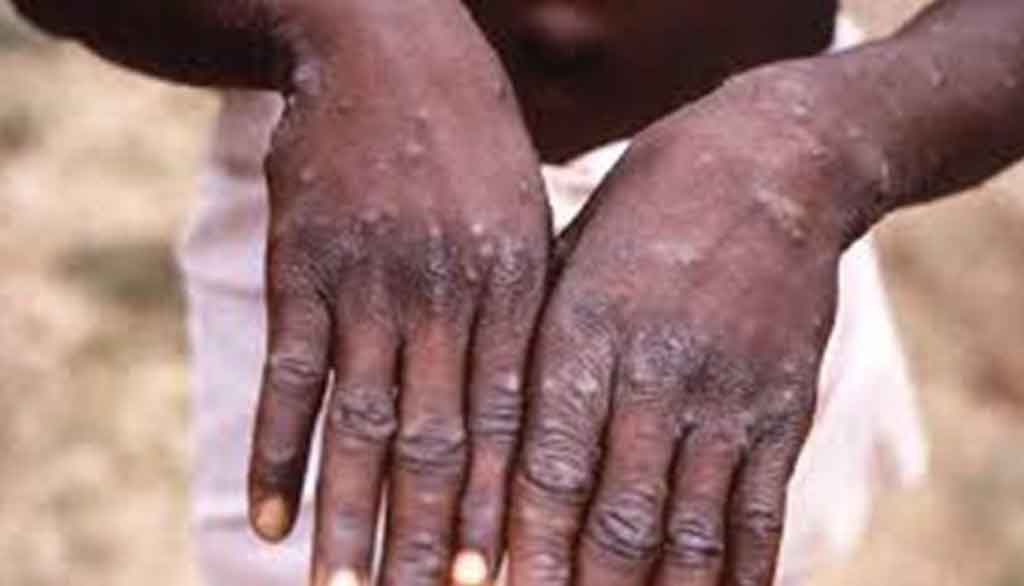 OPS llama a mantener vigilancia del mpox en las Américas OPS llama a mantener vigilancia del mpox en las Américas