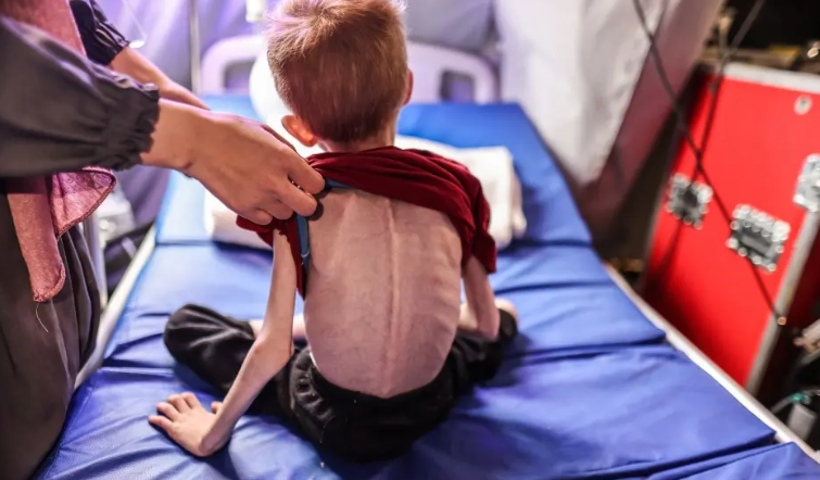 Más de 70 mil niños sufren desnutrición en Gaza Más de 70 mil niños sufren desnutrición en Gaza